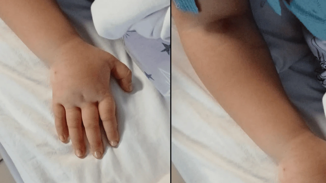 Eskişehir'de Şok İddia: Hemşire İhmali 5 Yaşındaki Çocuğun Kolunu Şişirdi! Aile Şikayetçi Oldu!