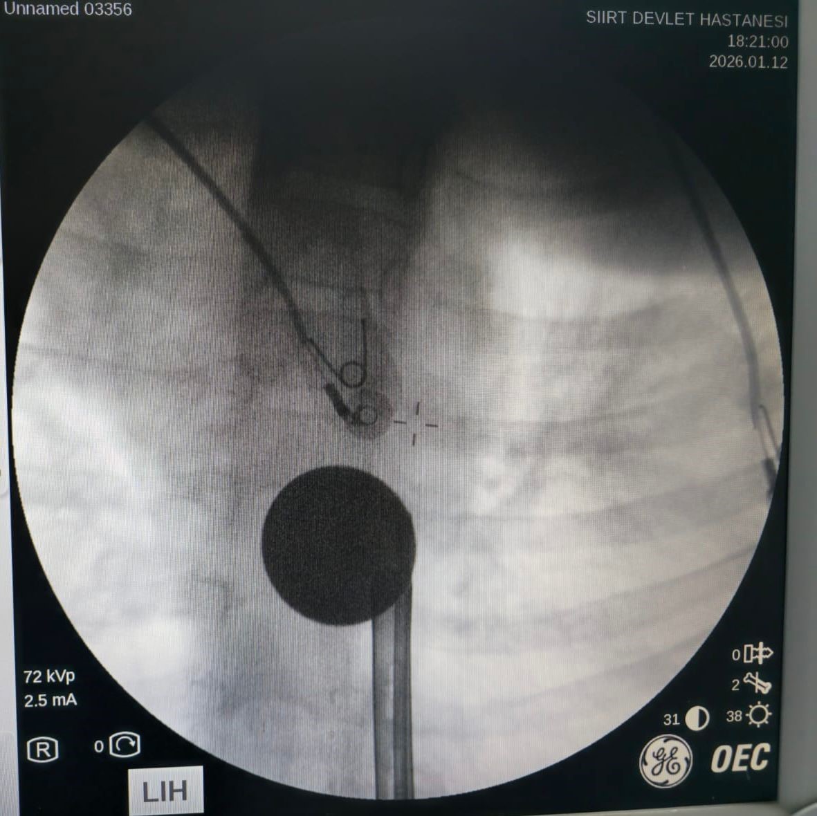Siirt’te boğazına madeni para kaçan çocuk, doktorların müdahalesi ile kurtarıldı