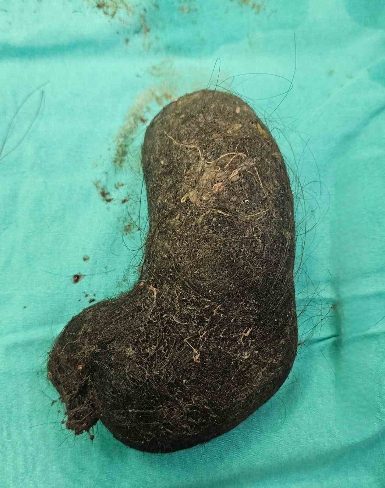 Minik kızın midesinden devasa bir saç yumağı çıktı