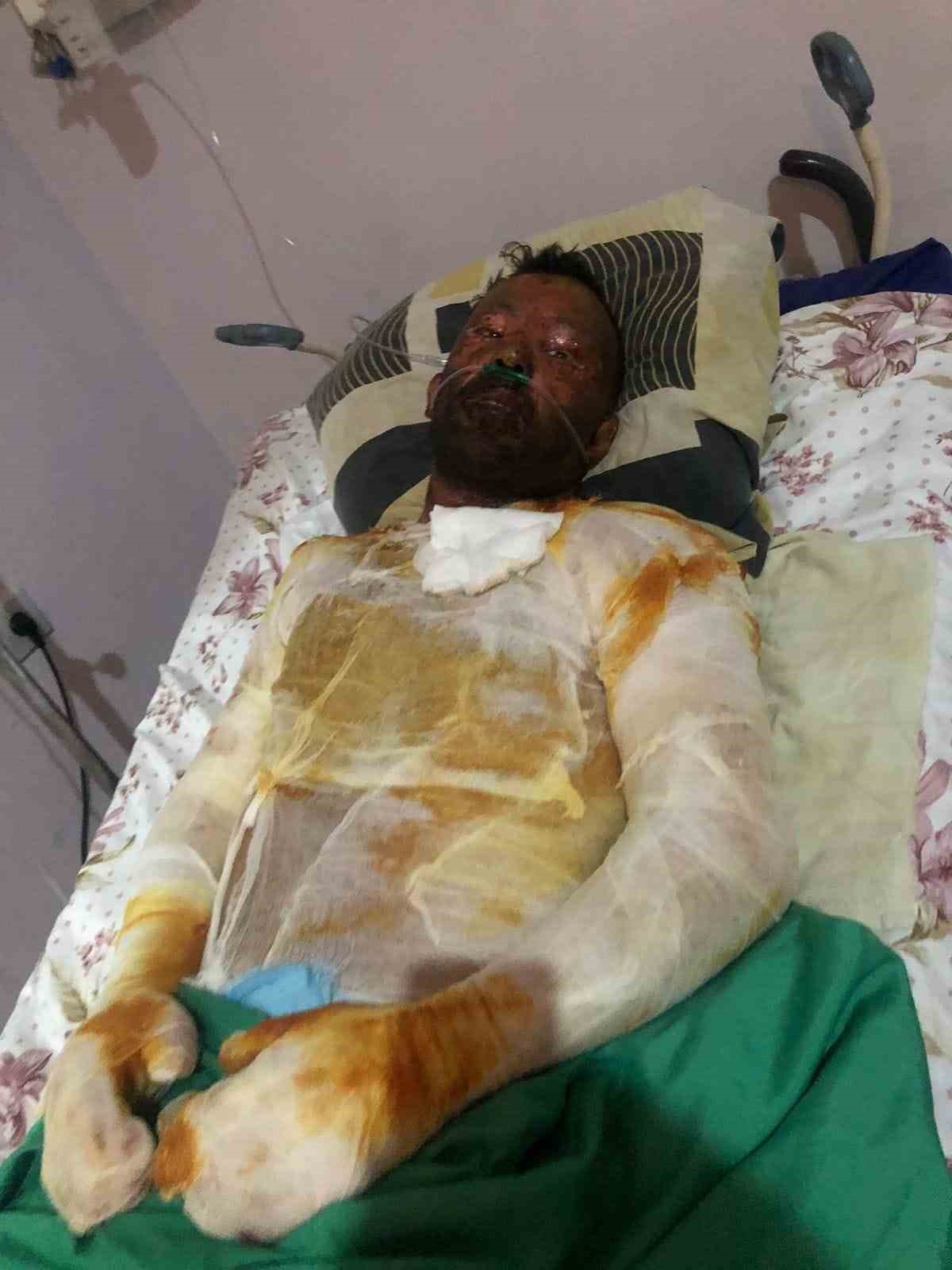 Azerbaycanlı çiftin doğal gaz patlamasında kapanan elleri, 3 yıl sonunda Eskişehir’deki tedaviyle kavuştu