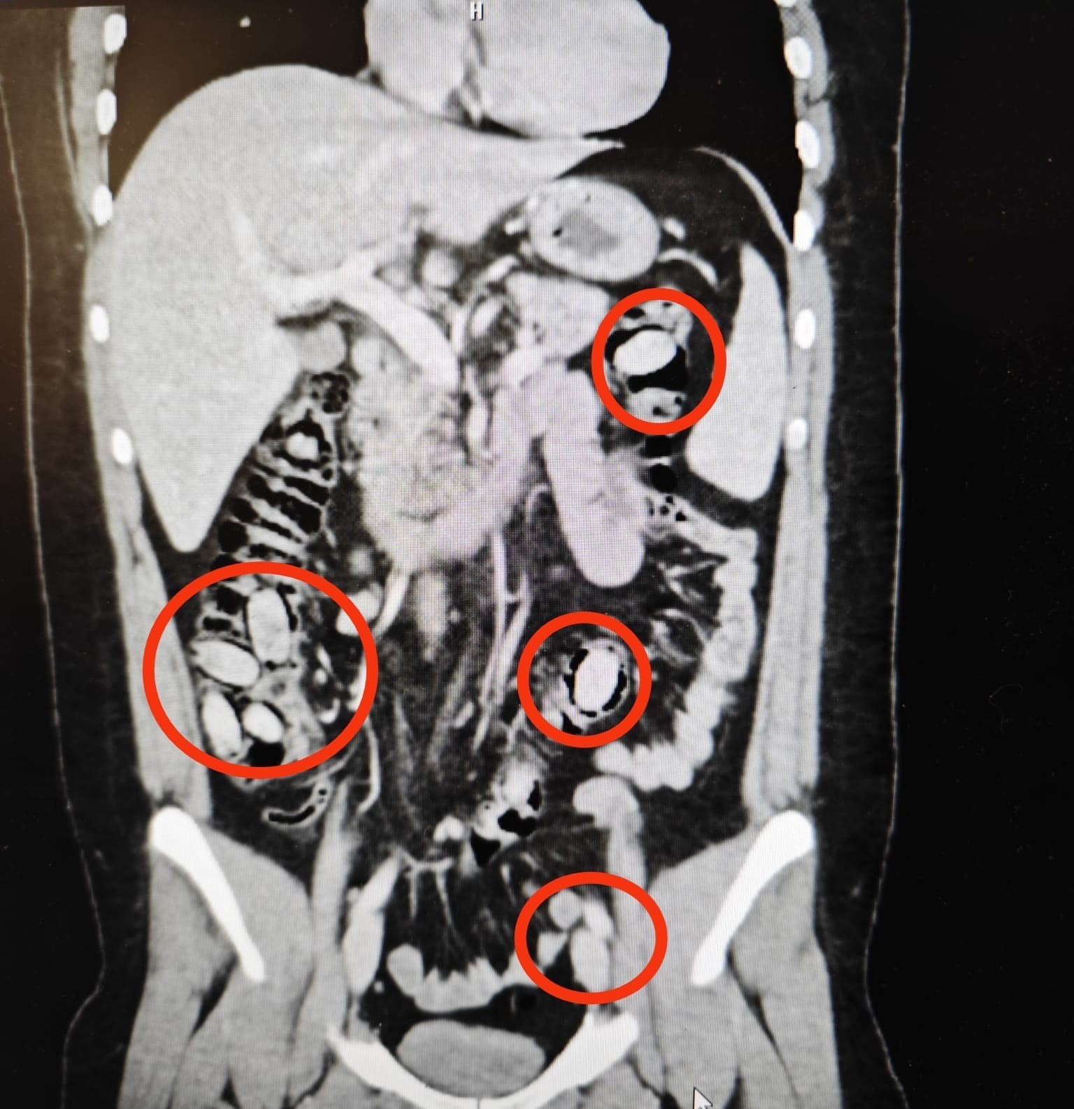 Midesinde taşıdığı uyuşturucu maddeler polisin dikkatinden sayesinde ele geçirildi