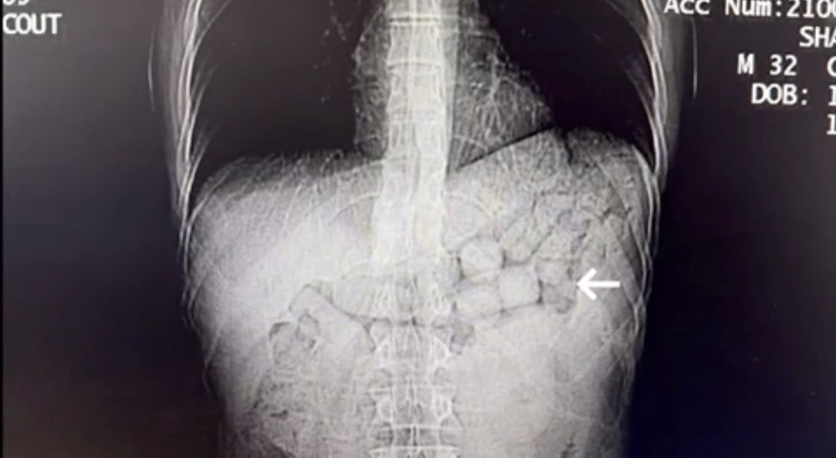 Midelerinde taşıdıkları 807 gram uyuşturucu ile yakalanan 2 kişi tutuklandı