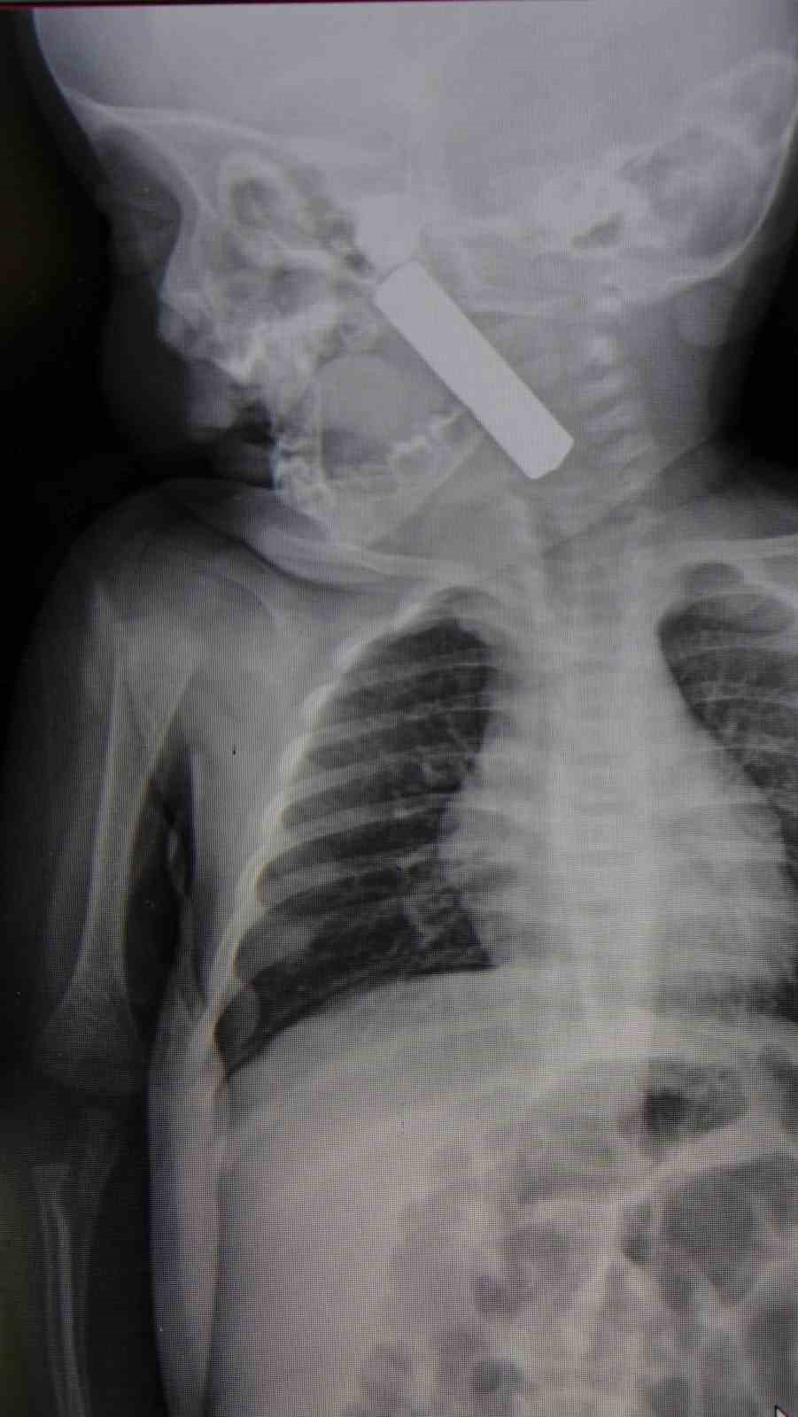 Karaman’da boğazına kumanda pili kalan kaçan bebek ölümden döndü